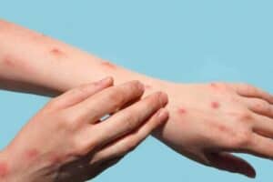 Health Department warns number of Mpox cases rising in SA