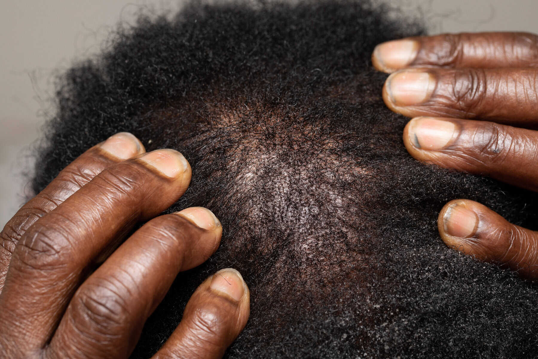 Hair loss Picture Istock