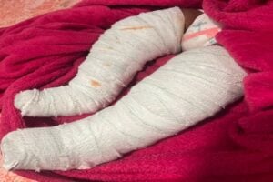 West Coast baby hospitalised with broken legs - suspected abuse probed