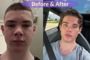 Clavicular, before and after.