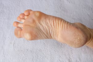 Feet health summer