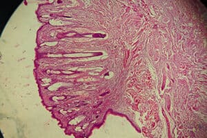 Histotripsy: using musical frequencies to destroy tumours among cancer patients